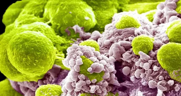 Tumori alla prostata: il raddoppio dei casi previsto entro il 2040