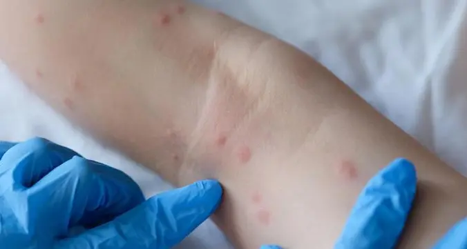 Epidemia di scabbia in carcere, dopo Bolzano anche a Trento? La denuncia del sindacato Sappe che chiede conferme