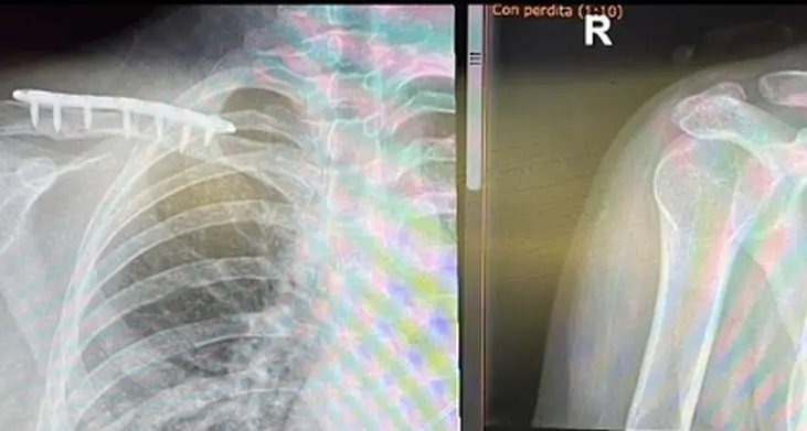 La riscossa di Letizia Paternoster: dopo l’operazione ringrazia tutti e pubblica le radiografie della clavicola