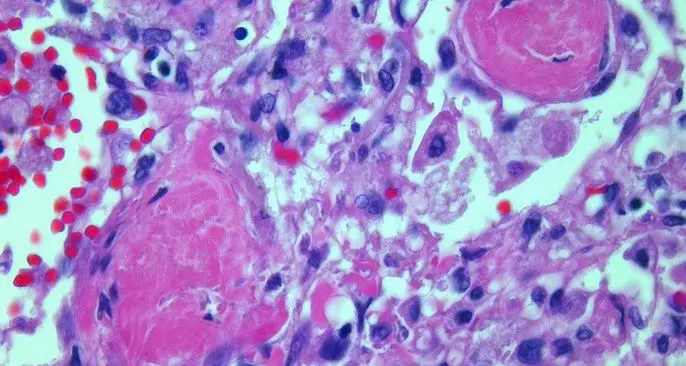 Così il Covid danneggia i polmoni: macro-cellule anomale e persistenti