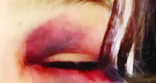 Giovani pestati di botte sabato notte a Tenna «Aggrediti dai proprietari davanti a un'abitazione» Una ragazza minorenne rischia di perdere un occhio