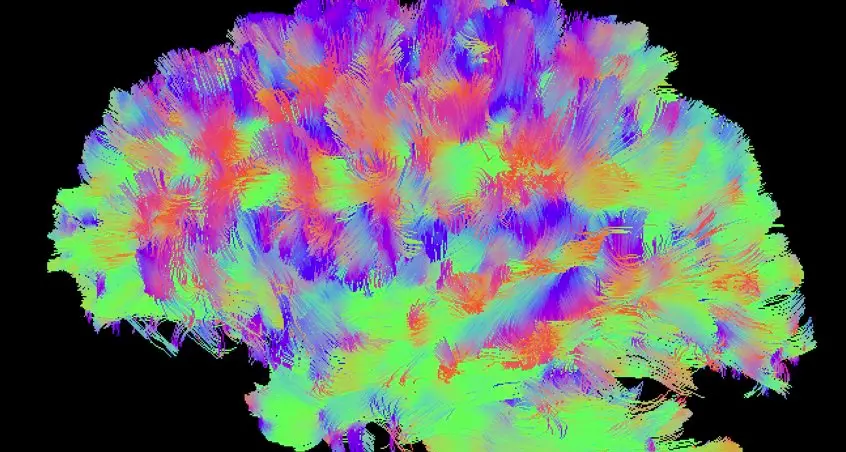 Nasce con metà cervello ma ha una intelligenza che è sopra la media