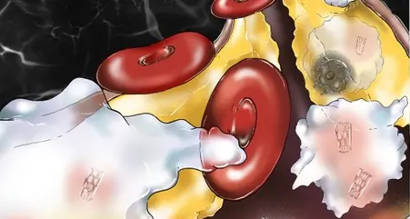 Nanoparticelle pac-man divorano le placche nelle arterie