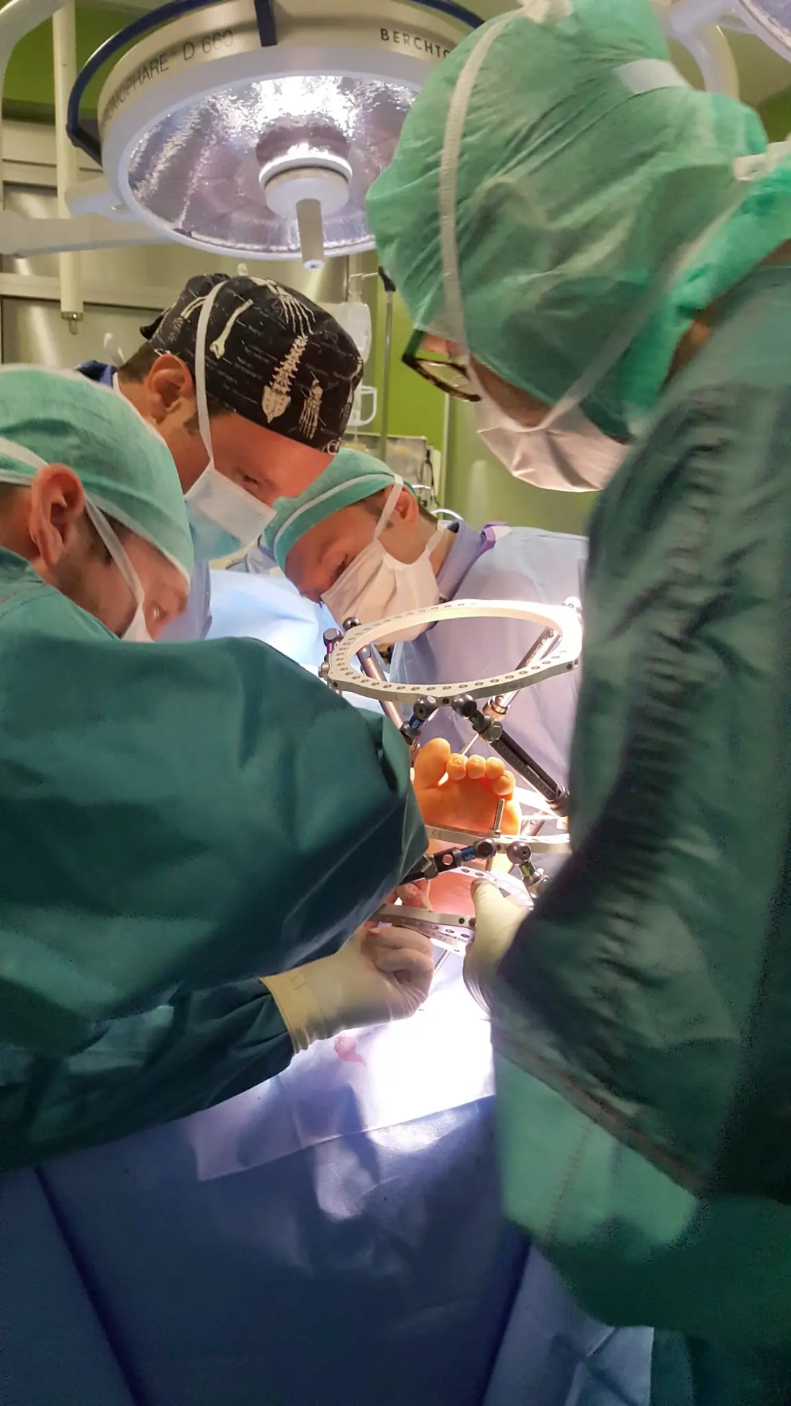 Operati all'ospedale Santa Chiara due bambini tornano a camminare Il chirurgo: «Prima volta in Trentino»