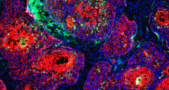 Nuovo studio sulle cause del cancro Non predestinazione ma fattori esterni come l'ambiente e lo stile di vita