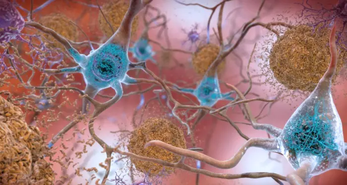 Alzheimer, scoperta molecola che blocca la malattia