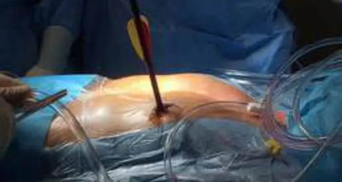 Freccia di balestra lunga 30 cm conficcata in cuore e polmone Operato e salvato