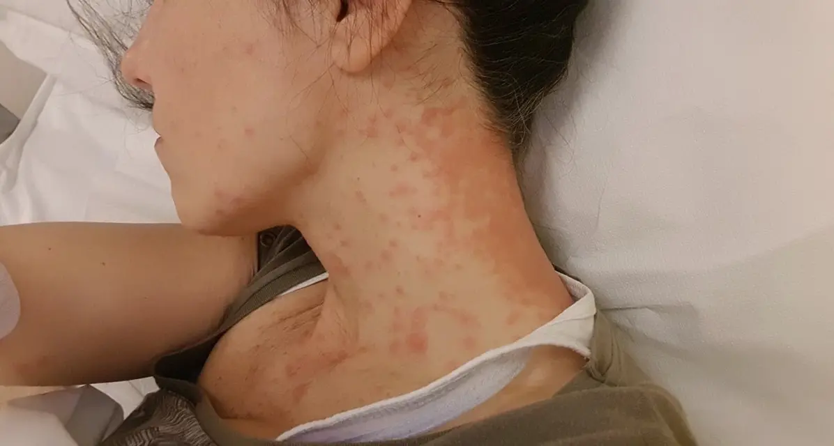 Urticata dalla processionaria, donna finisce in ospedale