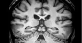 Asimmetrie cerebrali