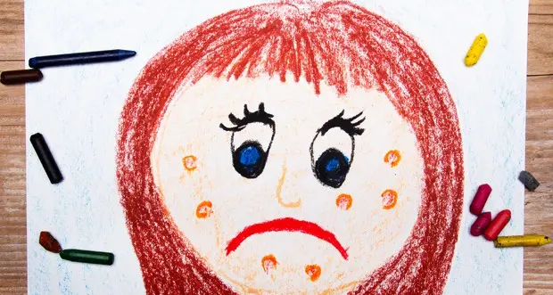 Morbillo: domande e risposte