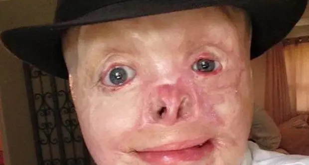 Il coraggio di Johnny, con ustioni su 95% corpo, sogna carriera da modello