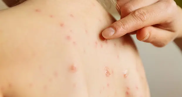 Francia, morbillo uccide 17enne È il terzo caso da inizio anno