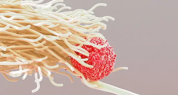 Tumore al seno con metastasi curato da cellule stessa paziente