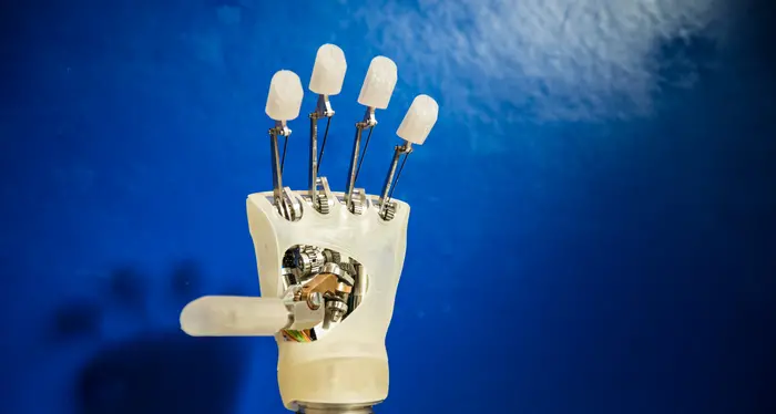 Mano bionica impiantata in una donna italiana