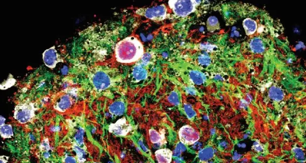 Prima infusione staminali nervose ad un malato di sclerosi multipla