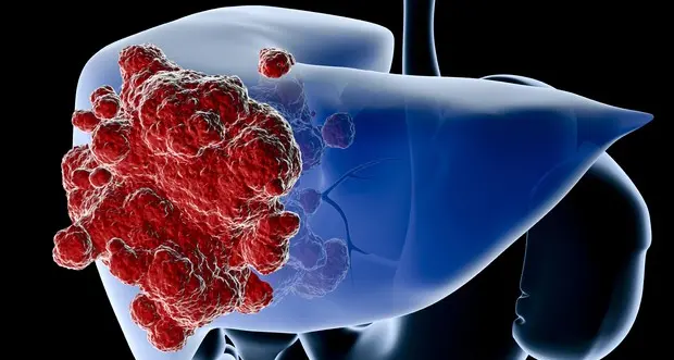 Tumore del fegato, l'immunoterapia aumenta la sopravvivenza dei pazienti