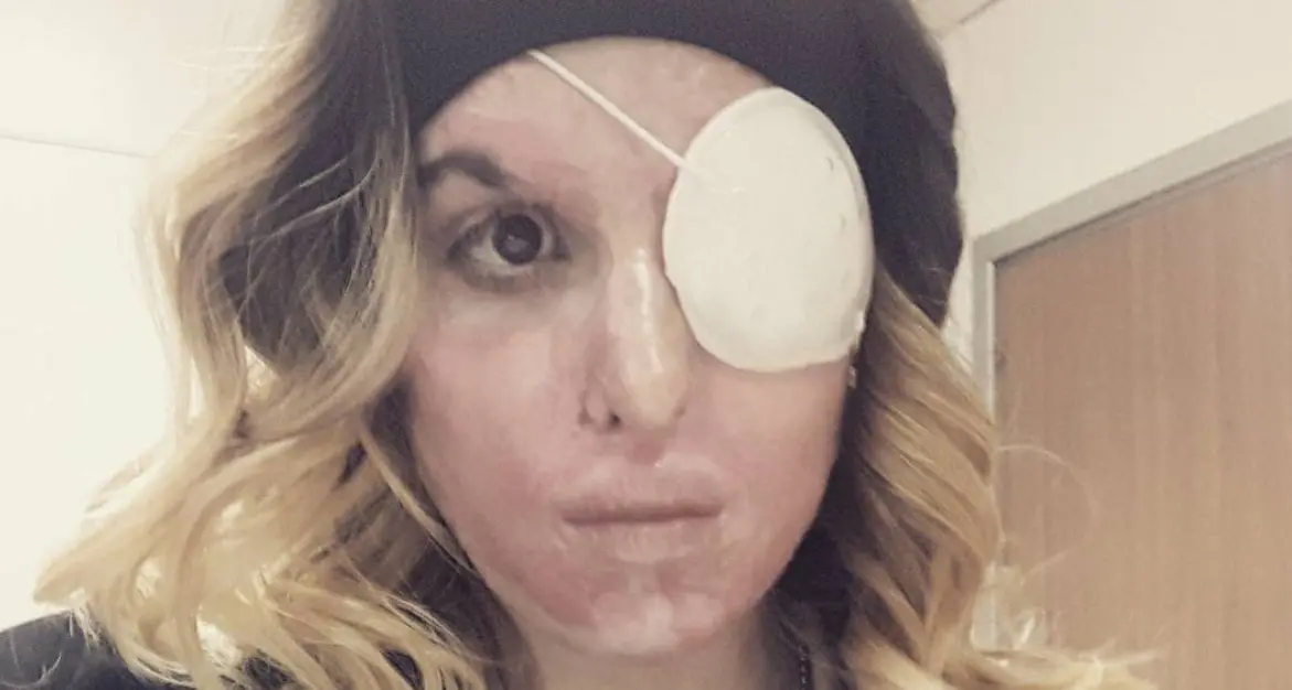Sfregiata con l'acido dal'ex posta un selfie su instagram