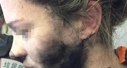 Auricolari esplodono in volo Ferita una donna australiana