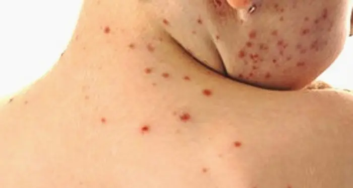Allerta morbillo, «viaggi a rischio» in Italia