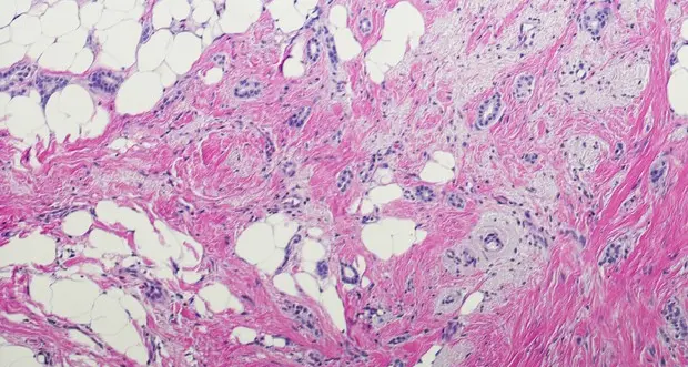Un vaccino terapeutico per il cancro al seno