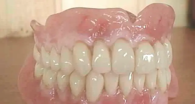 Dentiere e occhiali per i nuovi poveri