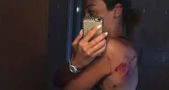 Predazzo, donna aggredita da un cane lasciato libero