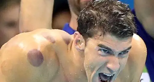 Phelps sfodera il «cupping» terapia antidolore cinese