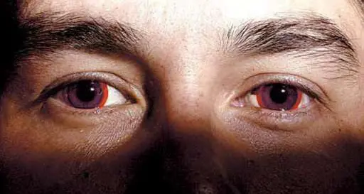 Sabbia e piscina nemici delle lenti a contatto Una persona al giorno perde la vista per infezione