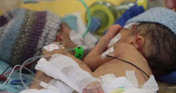 In Svizzera separate gemelle siamesi a otto giorni di vita