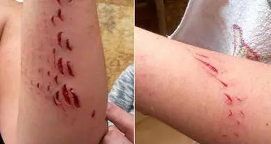 Squalo attacca donna. Lei mostra su Twitter la foto del braccio ferito