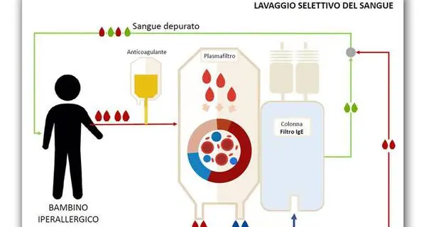 Bimbo salvato da un'allergia grave «lavando» il sangue
