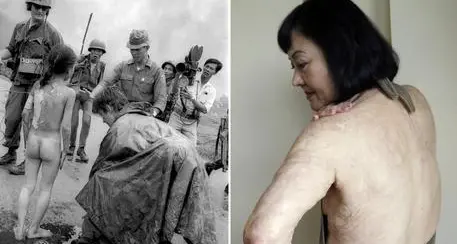 Dal laser una speranza per la 'bambina del Napalm'