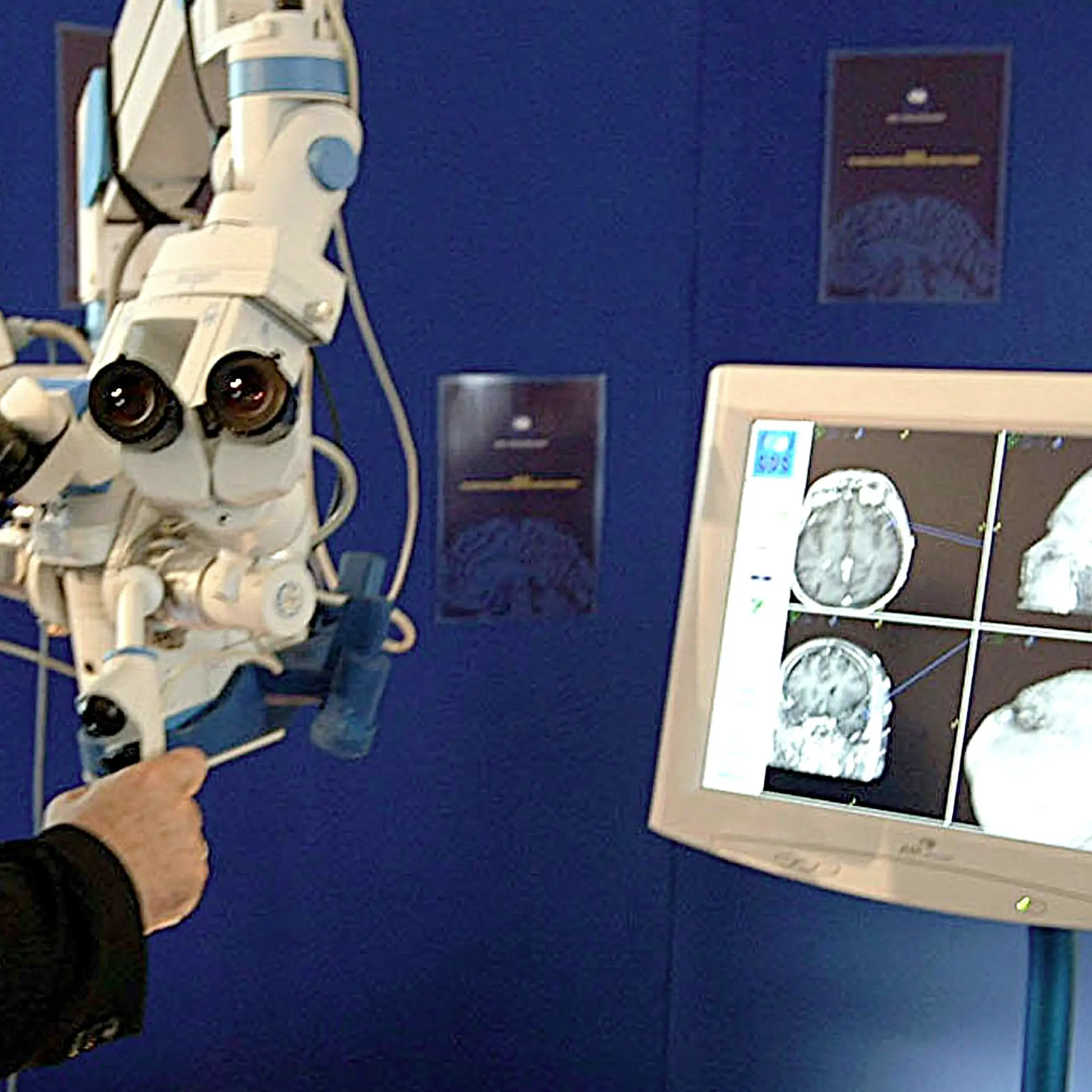 Bisturi contro l'epilessia: per varie forme l'80% di guarigioni