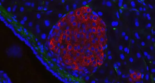 Un test delle urine per individuare rapidamente il cancro al pancreas