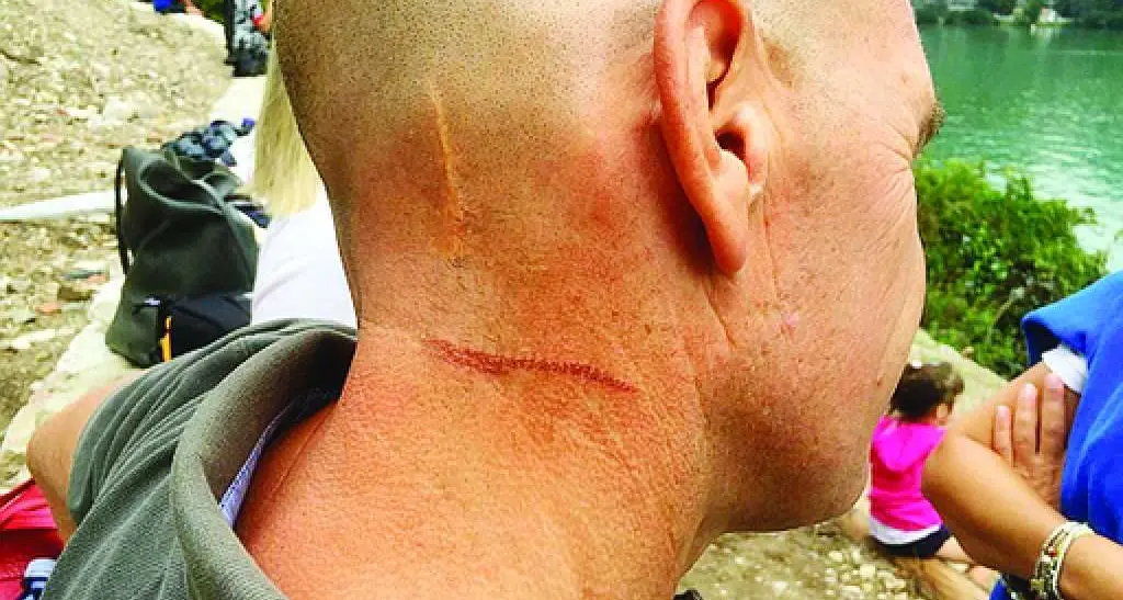 Ferito al collo da un kitesurf «Impossibile kite e surf insieme»