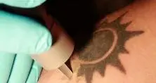 Via il tatuaggio La rimozione: video