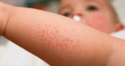 A Comano check-up gratis della pelle dei bambini