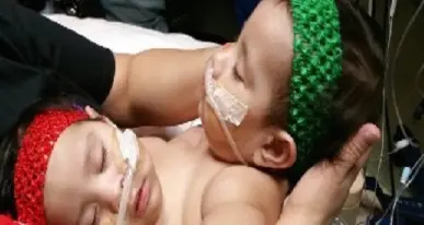 Usa, gemelle siamesi separate con intervento di 26 ore