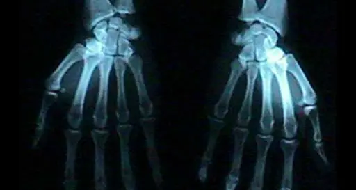 Radiologia «ridotta» a Tione senza servizio serale
