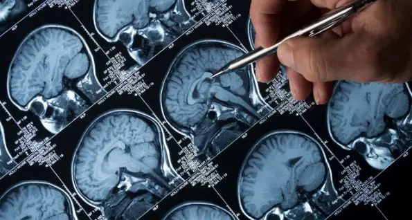 Gli effetti del Covid sul cervello: dalla perdita di memoria a forme di epilessia