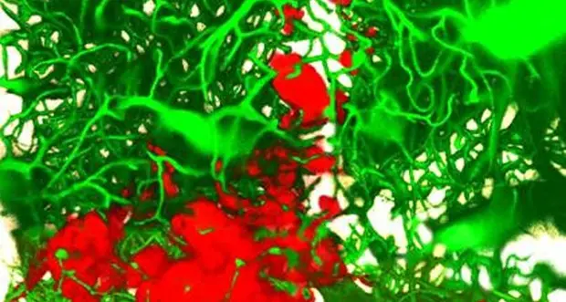 Un anticorpo monoclonale blocca la metastasi del tumore al seno