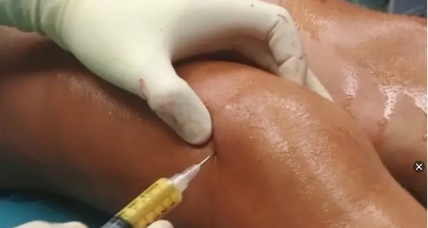 L'artrosi del ginocchio si può curare con iniezioni di adipe: parla il dottor Zorzi dell'ospedale di Negrar