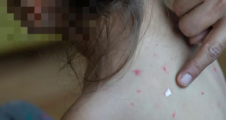 Caso di morbillo in un bimbo non vaccinato, pediatri allertati nelle valli di Fiemme e Fassa