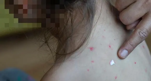 Quattro casi di morbillo negli adulti in Trentino, una persona ricoverata in ospedale