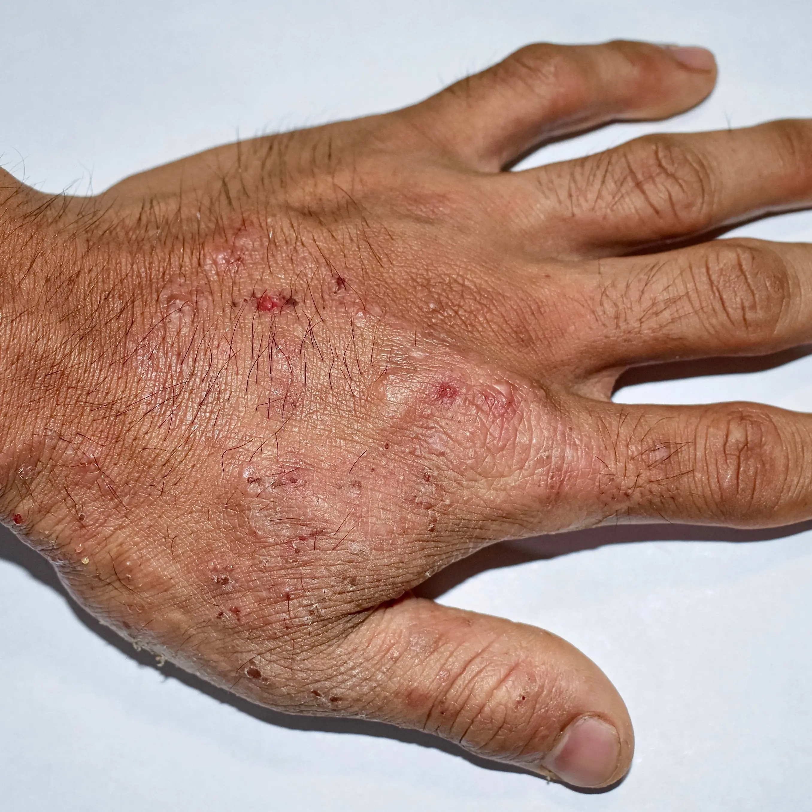 Scabbia, studio trentino su 1.751 pazienti: altri farmaci molto più efficaci della crema “tradizionale”