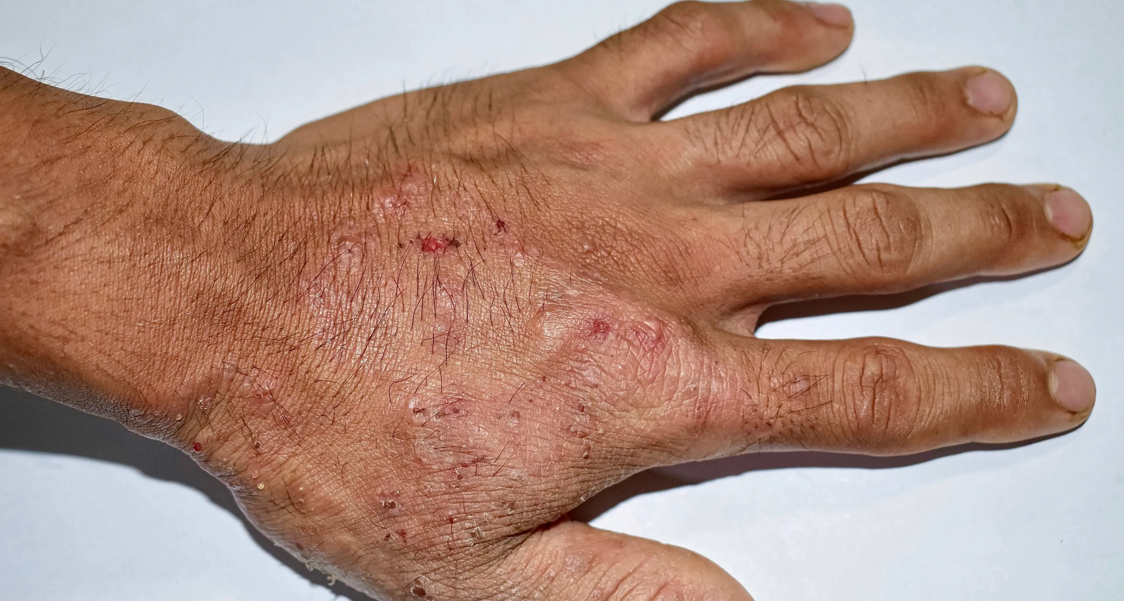 Scabbia, studio trentino su 1.751 pazienti: altri farmaci molto più efficaci della crema “tradizionale”
