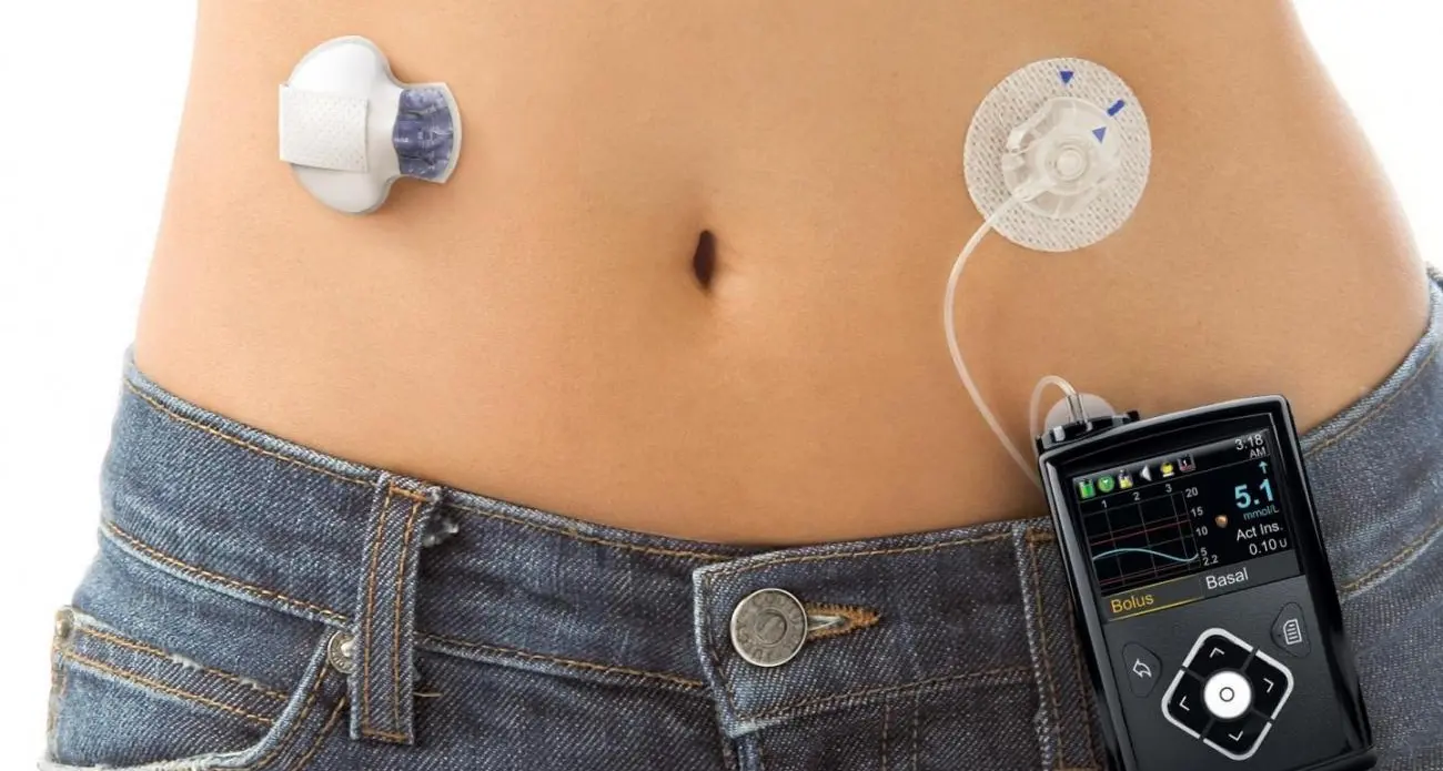 Pancreas artificiale per 40 giovani pazienti: il nuovo studio