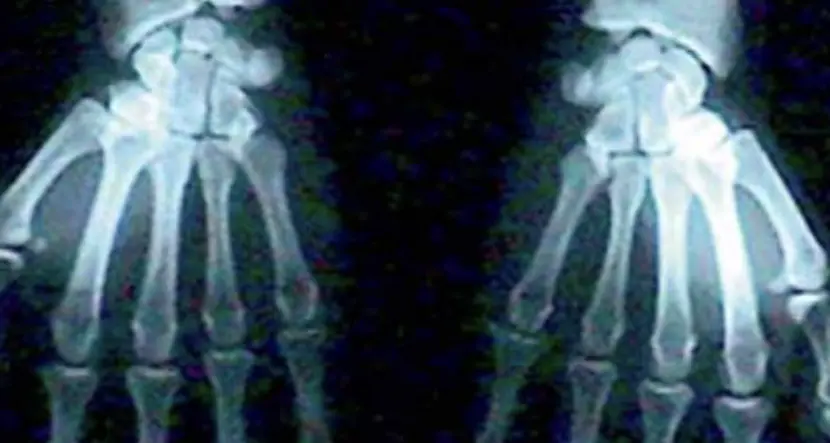 Raggi prescritti dagli infermieri, si cambia: esultano i tecnici di radiologia
