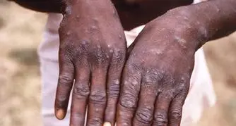 Vaiolo delle scimmie, l'Oms mette in guardia, pericolo festival e grandi assembramenti durante la prossima estate