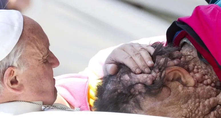 Morto a Vicenza Vinicio Riva: il bacio del Papa sul suo volto sfigurato aveva fatto il giro del mondo